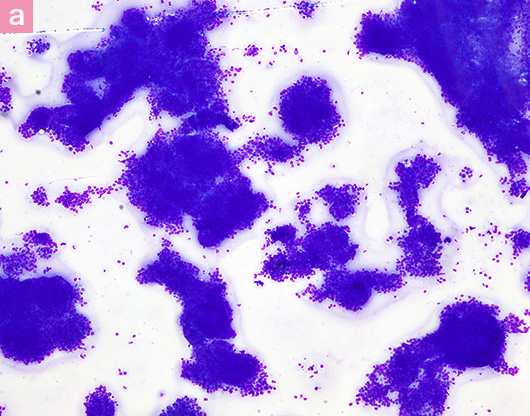 図7. 猫の乳腺癌の細胞診画像 a