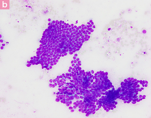 図7. 猫の乳腺癌の細胞診画像 b