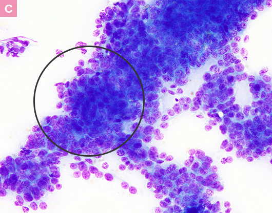 図7. 猫の乳腺癌の細胞診画像 c
