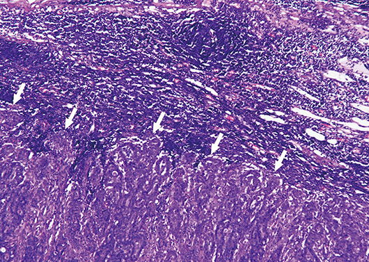 図21.乳腺癌のリンパ節転移を示す病理組織像