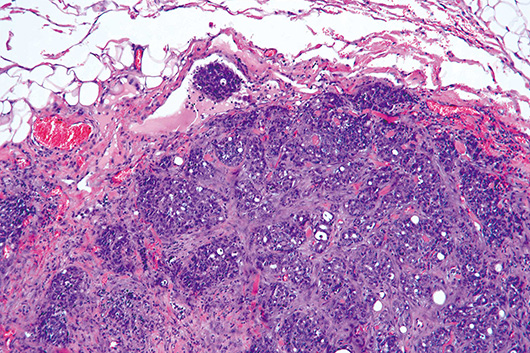 図22.乳腺癌のリンパ管内浸潤を示す病理組織像